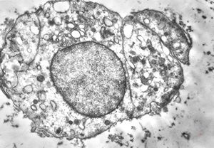 F, 62y. | myxoma atrii F, 62y. | myxoma atrii